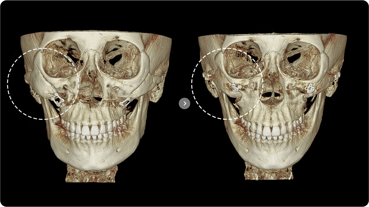일퍼센트성형외과의원 안면윤곽 - 안면윤곽 재수술