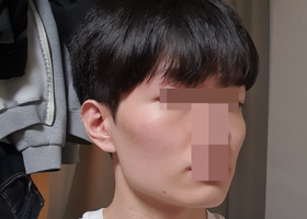 남자 안면윤곽
