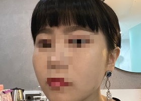 이래서 윤곽 수술을 하나봐요