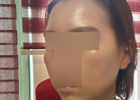 수술한지 4개월! 이제 붓기도 거의 빠졌어요