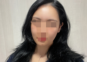 광대,지방이식,흡입 4개월차 >