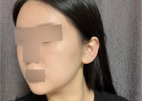 안면윤곽 3종 효과 제대로 본 후기