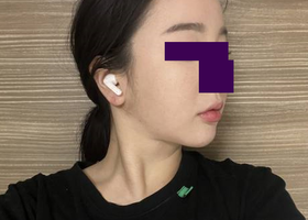 광대+얼굴지방흡입 후기