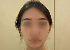 광대재수술, 사각턱, 지방이식 후기입니다