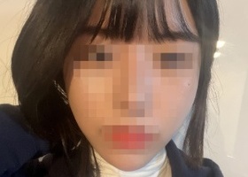 1종 광대했어요! 스트레스였던 광대가 아예 없어졌어요 