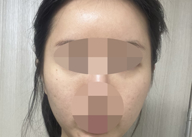 광대, 사각턱수술한지 1개월~