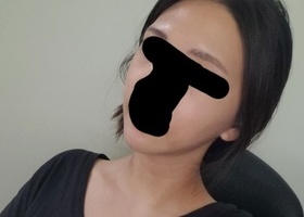 윤곽 2종 광대랑 사각턱 수술을 받은지 3개월이 되어 