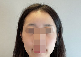 V라인~ 얼굴 지흡 받았어요