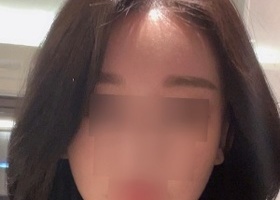 수술전 사진 볼때마다 이런얼굴로 어떻게 다녔지 생각도 
