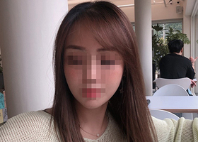 광대,미니v라인,풀페이스지방이식 4개월차 !