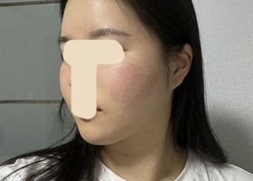 윤곽 재수술 후기