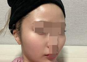 윤곽 사각턱, 광대 후기