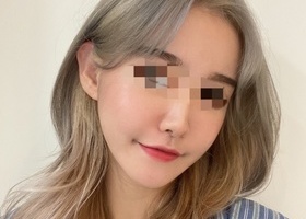 광대 턱 수술 1년차! 얼굴원래 작고 갸름한 사람인줄 