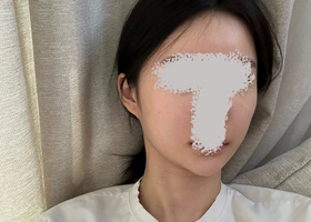 광대, 사각턱/ 윤곽 2종 후