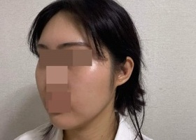 수술할때 제일 큰 걱정이 살처짐이랑 감각이었는데 그런 