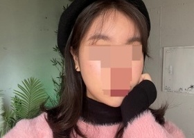 수술은 광대랑 사각턱 2종만 했는데 2종으로도 드라마틱