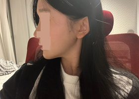 안면윤곽 3종한지 2개월