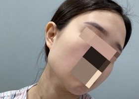 사각턱에 대한 스트레스가 컸는데 정말 사람이 이렇게 달
