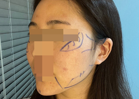 진작 수술할걸 ㅠㅠ 주변에서 예뻐졌다고 칭찬해줘요