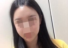 사각턱,앞턱수술,광대축소,피질절골 수술했습니다