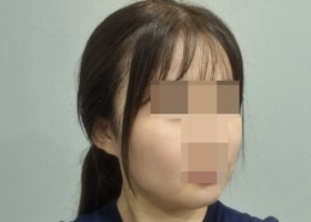 윤곽3종 3달차에요! 원래 위에서만 셀카찍었는데 밑에서