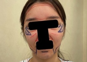 윤곽2종 재수술하기 싫어서 찐으로 발품 팔아서 수술했어