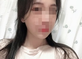수술직후 부터 바로 45도 광대는 확 사라진게 보였기 