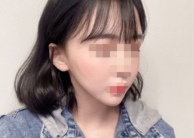 일퍼센트성형외과 임종우원장님께 윤곽수술 받은지 3개월차