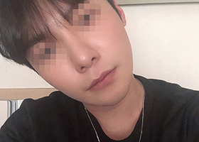 남자 사각턱,앞턱 2종 수술했어요 종이 한장 차이로 달