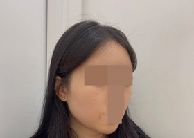 10월중순에 광대랑 사각턱 얼굴지방흡입 지방이식 받았어