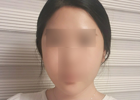 윤곽3종~ 이마축소 받은 후기!