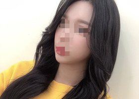 윤곽 3종 수술 후기입니당~ 비대칭이였는데 많이 좋아졌