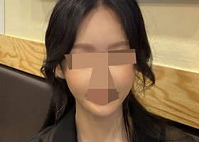 윤곽삼종 4개월차! 수술하고나니까 올림머리랑 할 때 아