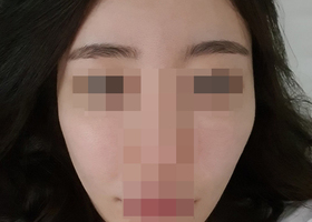 광대재수술~~ 후기입니다