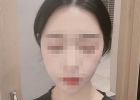 광대수술 2주일 되었어요~~^^
