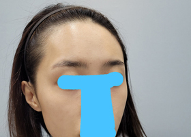 광대, 사각턱, 턱끝 벌써 5개월 후기~