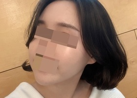 안면윤곽 2종 + 아큐지흡 3개월차 후기 효과는 드라마