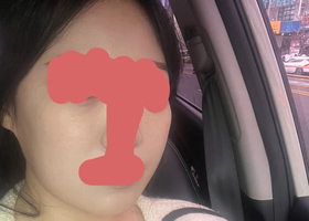 일퍼에서 턱 2종 수술했어요~~