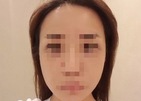 High-3D 광대, 비스포크 미니V라인, 풀페이스지방