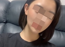윤곽수술 받은지 3개월차 후기입니다☺