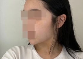 [광대 사각턱 2종 3개월차] 수술한거 아는 친구들이 