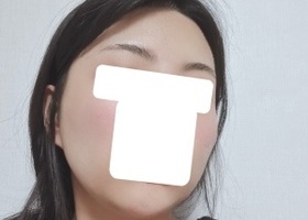광대는 재수술이였는데 수술하고 와 광대 제대로 넣어주셨
