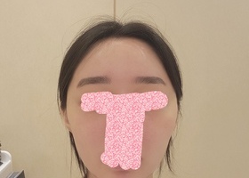광대, 턱수술 했는데 너무 행복해요~~