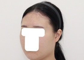 제일 신경쓰였던 얼굴비대칭, 턱끝길이, 사각턱 개선이 
