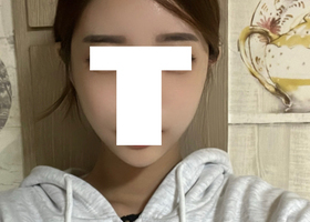 광대, 사각턱, 앞턱, 지방이식 수술 후기입니다!