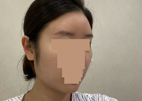 윤곽 수술한지 벌써 1년이 지났어요~