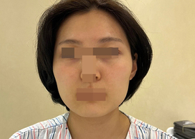 광대랑 사각턱 수술한지 4개월차 후기!!