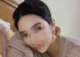 광대,지방흡입 9달차 ♡.♡