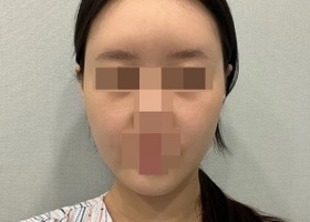 현재 붓기가 있지만 확실히 만져보면 옆광대도 아예 없어