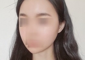 일퍼센트에서 윤곽 3종수술한지 2주차입니다.